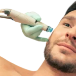ALFA MEDICO D.o.o._Mikrodermoabr