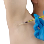 ALFA MEDICO D.o.o._Potenje Botox