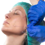 Alfa MEDICO_PDO NITKE