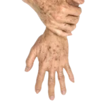 Alfa Medico D.o.o._Pigmentacije