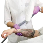 Alfa Medico D.o.o._Tetovaže