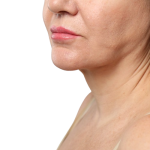 Nekirur&scaron;ki Lifting S PDO Nitkami