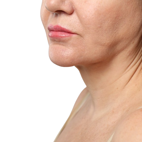 Nekirurški Lifting S PDO Nitkami