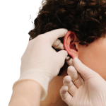 Otoplastika Korekcija &scaron;trlečih U&scaron;es Alfa Medico