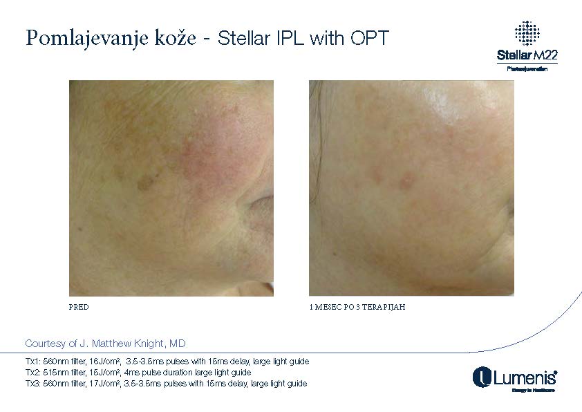 STELLAR BEFORE AFTER, PREVOD_Page_014