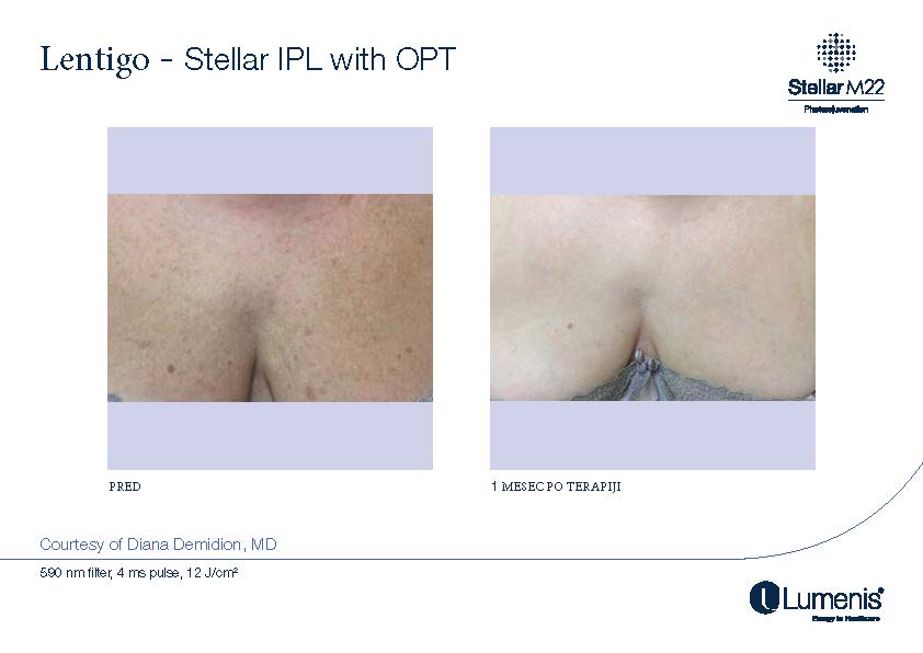 STELLAR BEFORE AFTER, PREVOD_Page_018